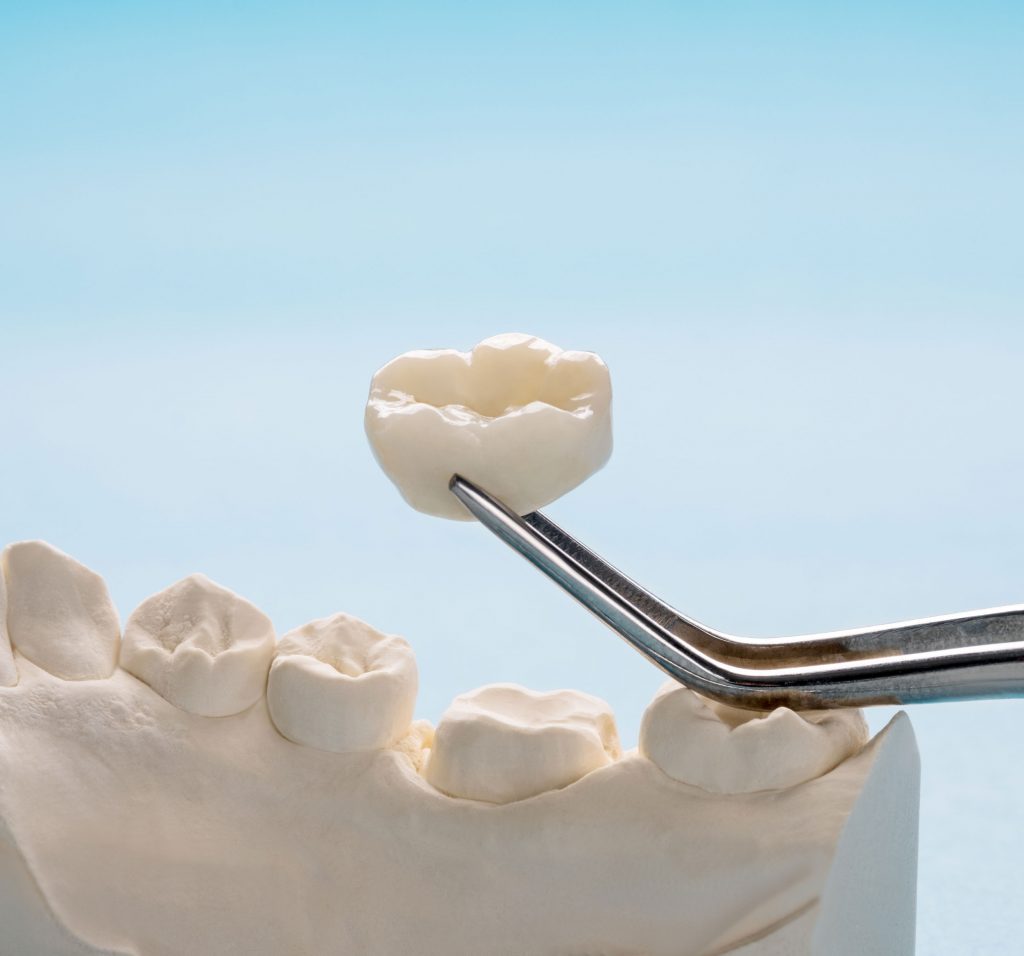 Ceramics Ottawa Dental Laboratory