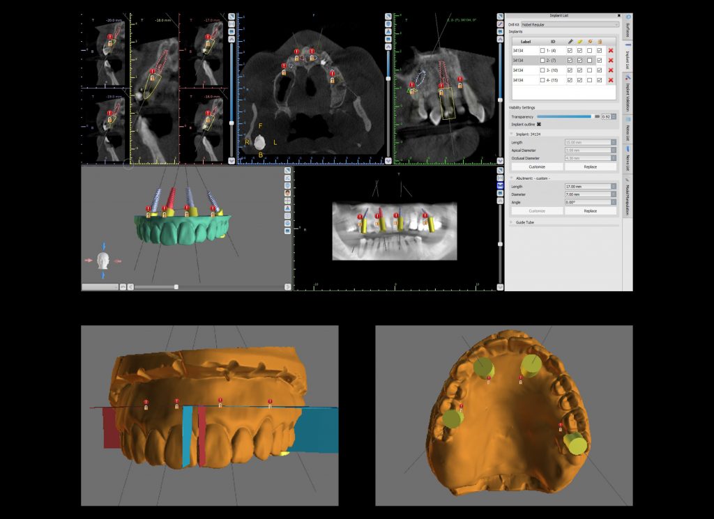 Chrome1 Ottawa Dental Laboratory