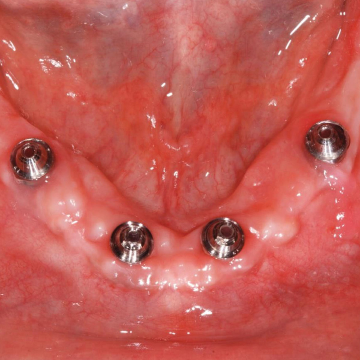 Product_Image_Implants Ottawa Dental Laboratory