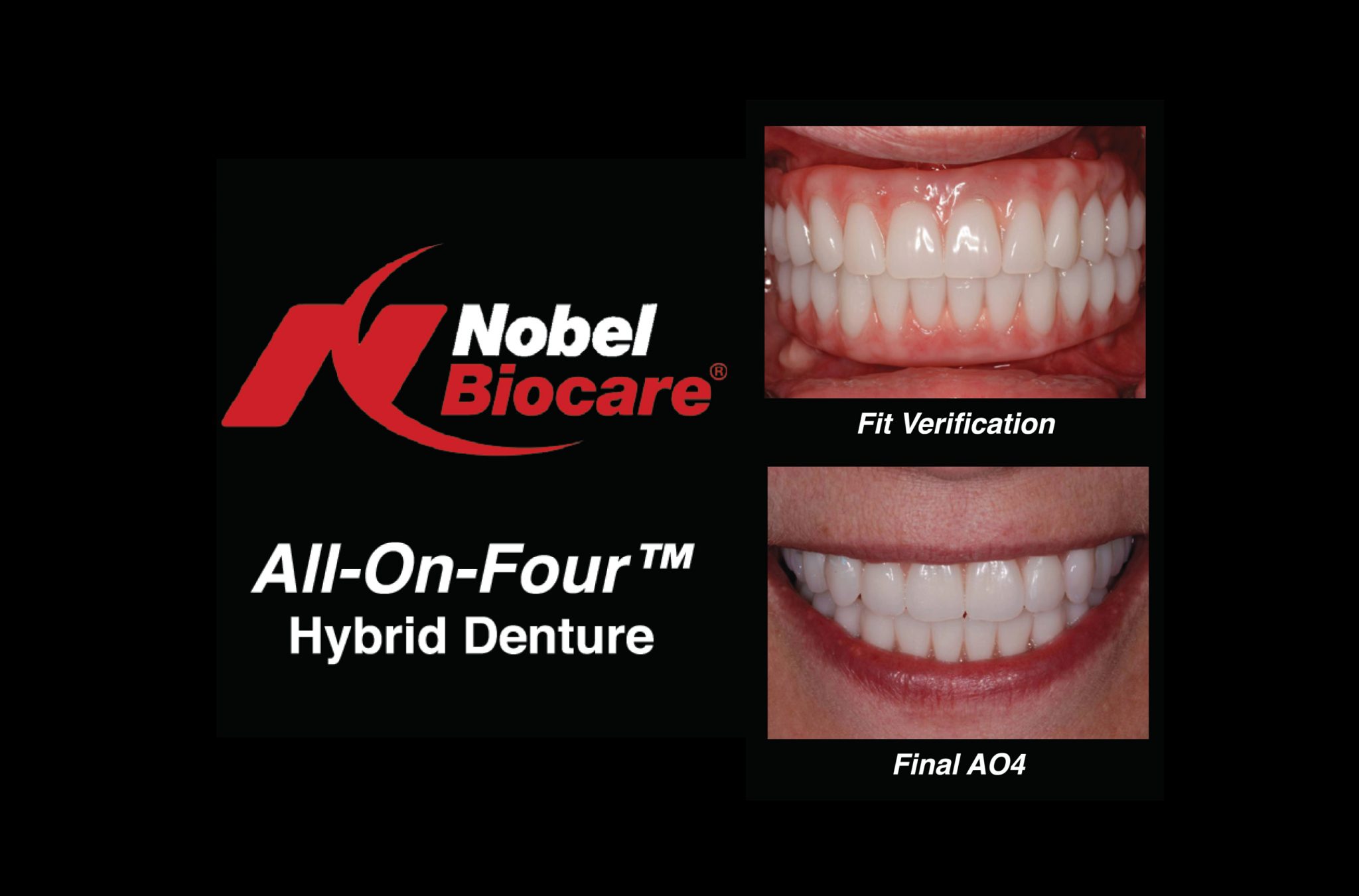 AllOnFour™ Conversions Ottawa Dental Laboratory LLC